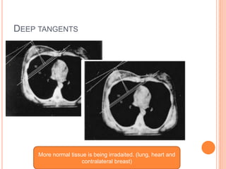 DEEP TANGENTS
More normal tissue is being irradaited. (lung, heart and
contralateral breast)
 