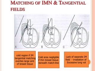 MATCHING OF IMN & TANGENTIAL
FIELDS
cold region if IM
tangential matching
overlies large amt
of breast tissue
Cold area negligible
if thin breast tissue
beneath match-line
Lack of separate IM
field - irradiation of
Excessive lung vol
 