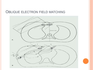 OBLIQUE ELECTRON FIELD MATCHING
 