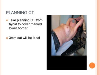 PLANNING CT
 Take planning CT from
hyoid to cover marked
lower border
 3mm cut will be ideal
 