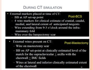 DURING CT SIMULATION
Post-BCS
Post-Mastectomy
 