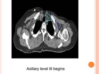 Axillary level III begins
 