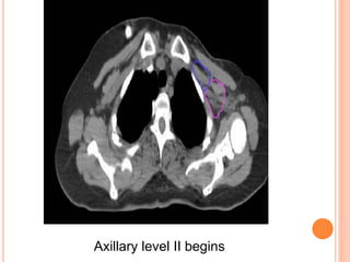 Axillary level II begins
 
