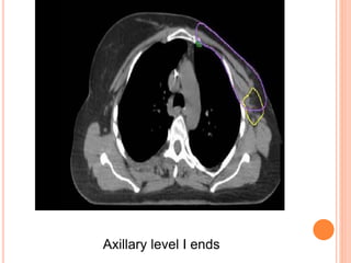 Axillary level I ends
 