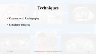 Radiotherapy Treatment Planning Procedure.pptx
