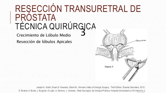 Reseccion Transuretral de Prostata, tecnica quirurgica