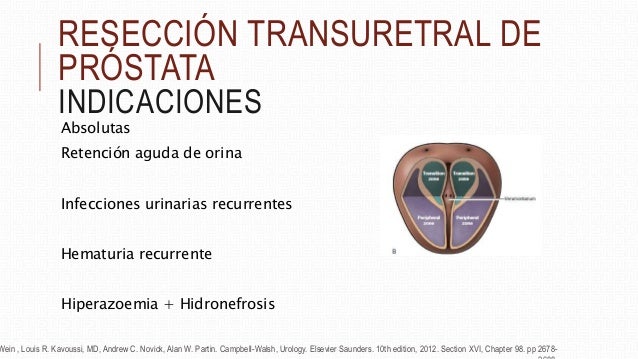 Reseccion Transuretral de Prostata, tecnica quirurgica