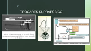 z
TROCARES SUPRAPÚBICO
 