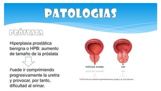 Cáncer de próstata:
Se produce cuando algunas
células prostáticas mutan y
comienzan a multiplicarse
descontroladamente.
FU...