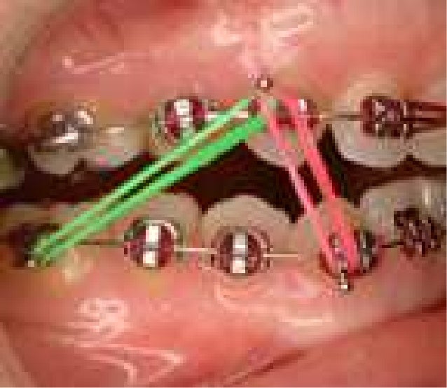 Glauser Williams Orthodontics Rubber Bands Used in Orthodontic Treatment
