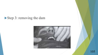 Step 3: removing the dam
105
 