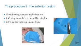 The procedure in the anterior region
 The following steps are applied for use:
 1. Cutting away the relevant rubber nipp...
