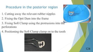 Procedure in the posterior region
1. Cutting away the relevant rubber nipples
2. Fixing the Opti Dam into the frame
3. Fix...