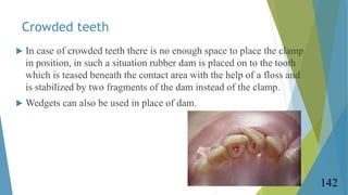Crowded teeth
 In case of crowded teeth there is no enough space to place the clamp
in position, in such a situation rubb...