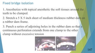 Fixed bridge isolation
1. Anesthetize with topical anesthetic the soft tissues around the
teeth to be clamped.
2. Stretch ...