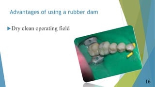 Advantages of using a rubber dam
Dry clean operating field
16
 