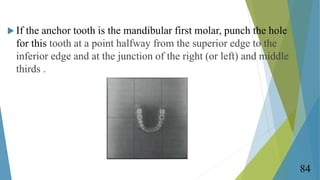  If the anchor tooth is the mandibular first molar, punch the hole
for this tooth at a point halfway from the superior ed...