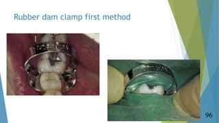 Rubber dam clamp first method
96
 