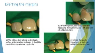 Everting the margins
98
a) The rubber dam is lying on the tooth
surface and may allow leakage. It should be
everted into t...