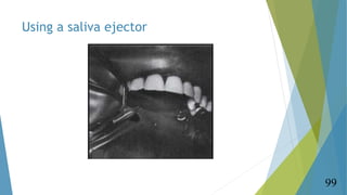 Using a saliva ejector
99
 