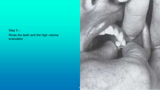 51
Step 6 :-
Lay the teeth of rubber dam over a light -
coloured flat surface or hold it it up to the
operating light to d...