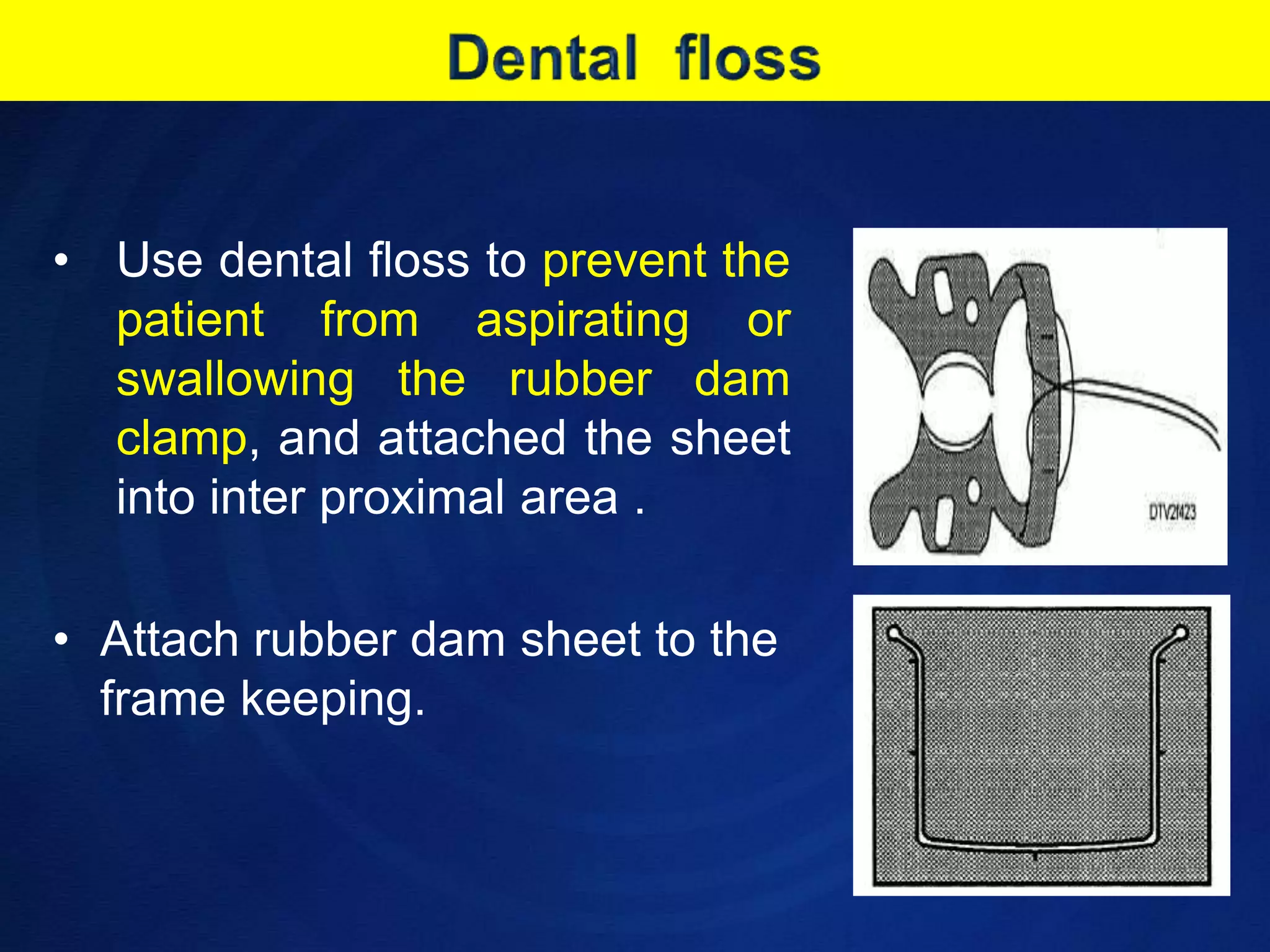 Dental  flossUse dental floss to prevent the patient from aspirating or swallowing the rubber dam clamp, and attached the sheet into inter proximal area .Attach rubber dam sheet to the frame keeping.