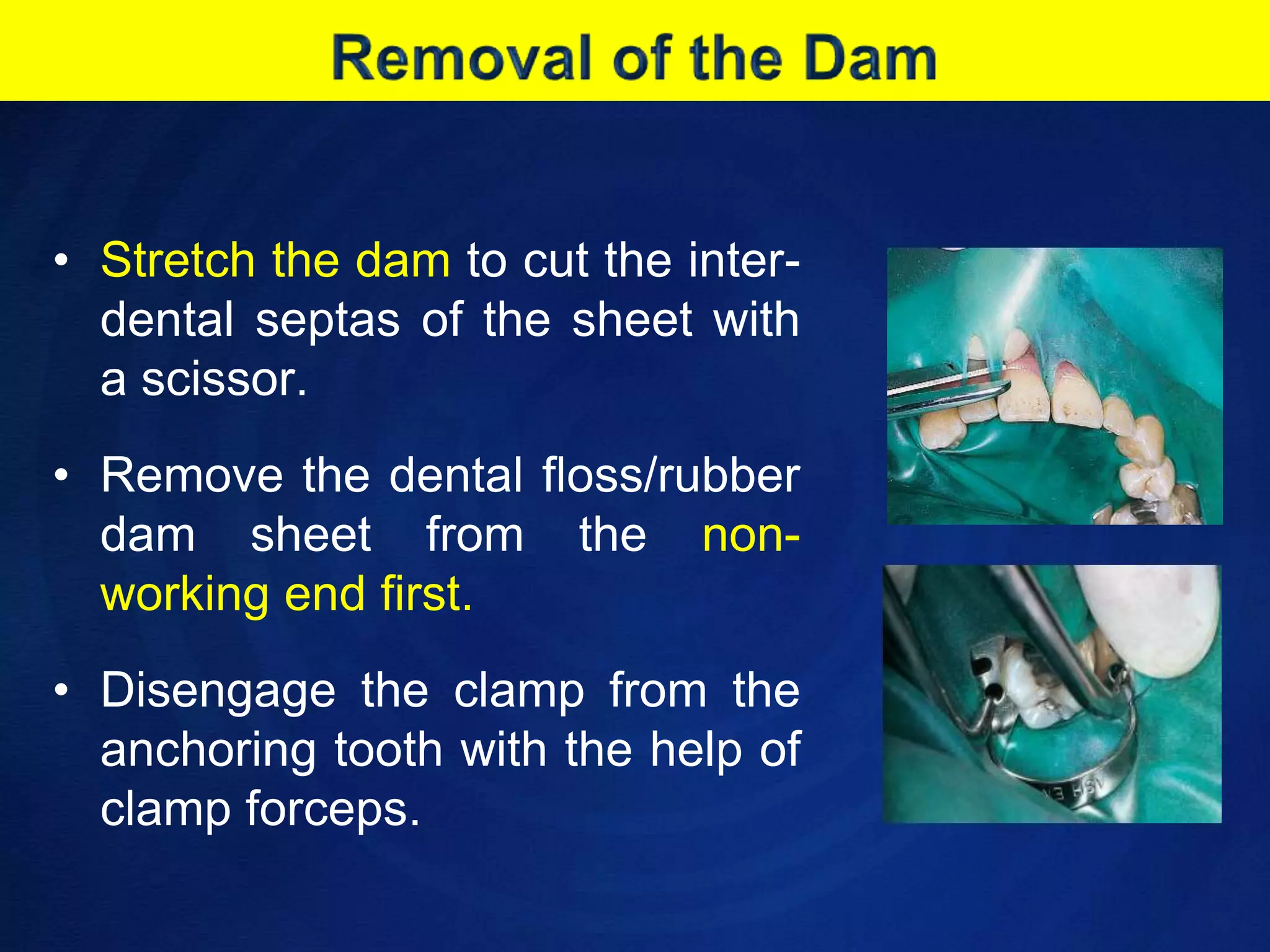 Removal of the DamStretch the dam to cut the inter-dental septas of the sheet with a scissor.Remove the dental floss/rubber dam sheet from the non-working end first.Disengage the clamp from the anchoring tooth with the help of clamp forceps.