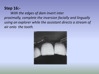 Step 17:-
     The use of a saliva ejector is optional because most
patient are able and usually prefer to swallow the
sal...