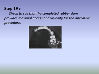Step 20 :-
     For the proximal surface preparations many
operators consider the insertion of inter proximal wedges
as th...