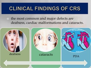  the most common and major defects are
deafness, cardiac malformations and cataracts.
deafness cataracts PDA
 
