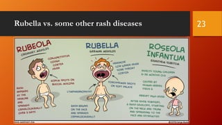 Rubella vs. some other rash diseases 23
 