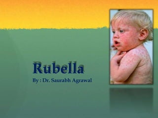 Rubella
By : Dr. Saurabh Agrawal
 