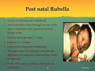 Rubella | PPTX