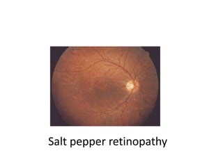 Salt pepper retinopathy
 