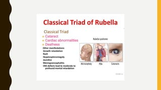 Rubell Machine Rubella | PPTX