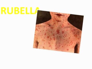 RUBELLA
 