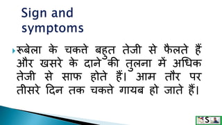 रूबेला क
े चकत्ते बहुत तेिी से फ
ै लते हैं
और खसरे क
े दाने की तुलना में अधिक
तेिी से साफ होते हैं। आम तौर पर
तीसरे ददन तक चकत्ते गायब हो िाते हैं।
 