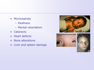 • Microcephaly
   – Deafness
   – Mental retardation
• Cataracts
• Heart defects
• Bone alterations
• Liver and spleen damage
 
