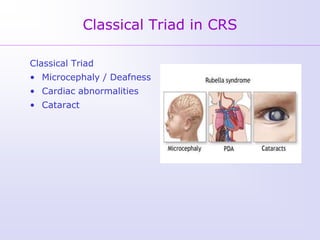 Classical Triad in CRS

Classical Triad
• Microcephaly / Deafness
• Cardiac abnormalities
• Cataract
 