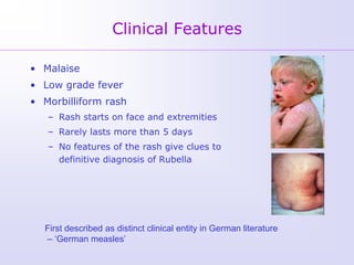 Clinical Features

• Malaise
• Low grade fever
• Morbilliform rash
   – Rash starts on face and extremities
   – Rarely lasts more than 5 days
   – No features of the rash give clues to
     definitive diagnosis of Rubella




  First described as distinct clinical entity in German literature
  – ‘German measles’
 