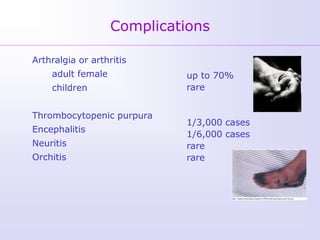 Complications

Arthralgia or arthritis
    adult female            up to 70%
    children                rare


Thrombocytopenic purpura
                            1/3,000 cases
Encephalitis
                            1/6,000 cases
Neuritis                    rare
Orchitis                    rare
 