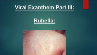 Viral Exanthem Part III:
Rubella:
 