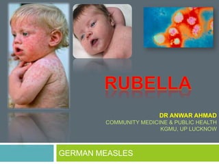 GERMAN MEASLES
DR ANWAR AHMAD
COMMUNITY MEDICINE & PUBLIC HEALTH
KGMU, UP LUCKNOW
 