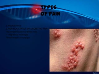 TYPES
OF PAIN
1.NOCICEPTIVE
2.NON NOCICEPTIVE (NEUROPATHIC PAIN)
Neuropathic pain is divide into
* Trigrminal neuralgia
*Postherpetic neuralgia

 