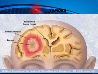 TUMORS

 