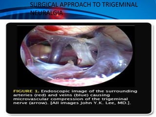 SURGICAL APPROACH TO TRIGEMINAL
NEURALGIA

 