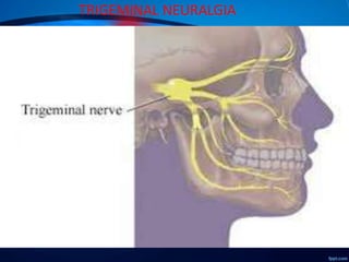 TRIGEMINAL NEURALGIA

 