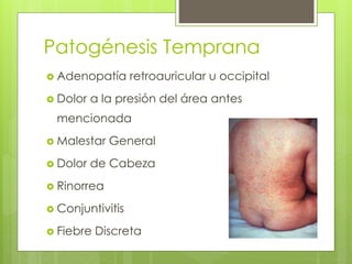 Patogénesis Temprana
 Adenopatía retroauricular u occipital
 Dolor a la presión del área antes
mencionada
 Malestar General
 Dolor de Cabeza
 Rinorrea
 Conjuntivitis
 Fiebre Discreta
 