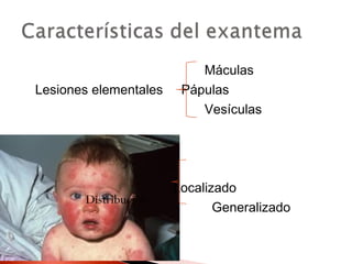 Máculas 
Lesiones elementales Pápulas 
Vesículas 
Localizado 
D istribución Generalizado 
 