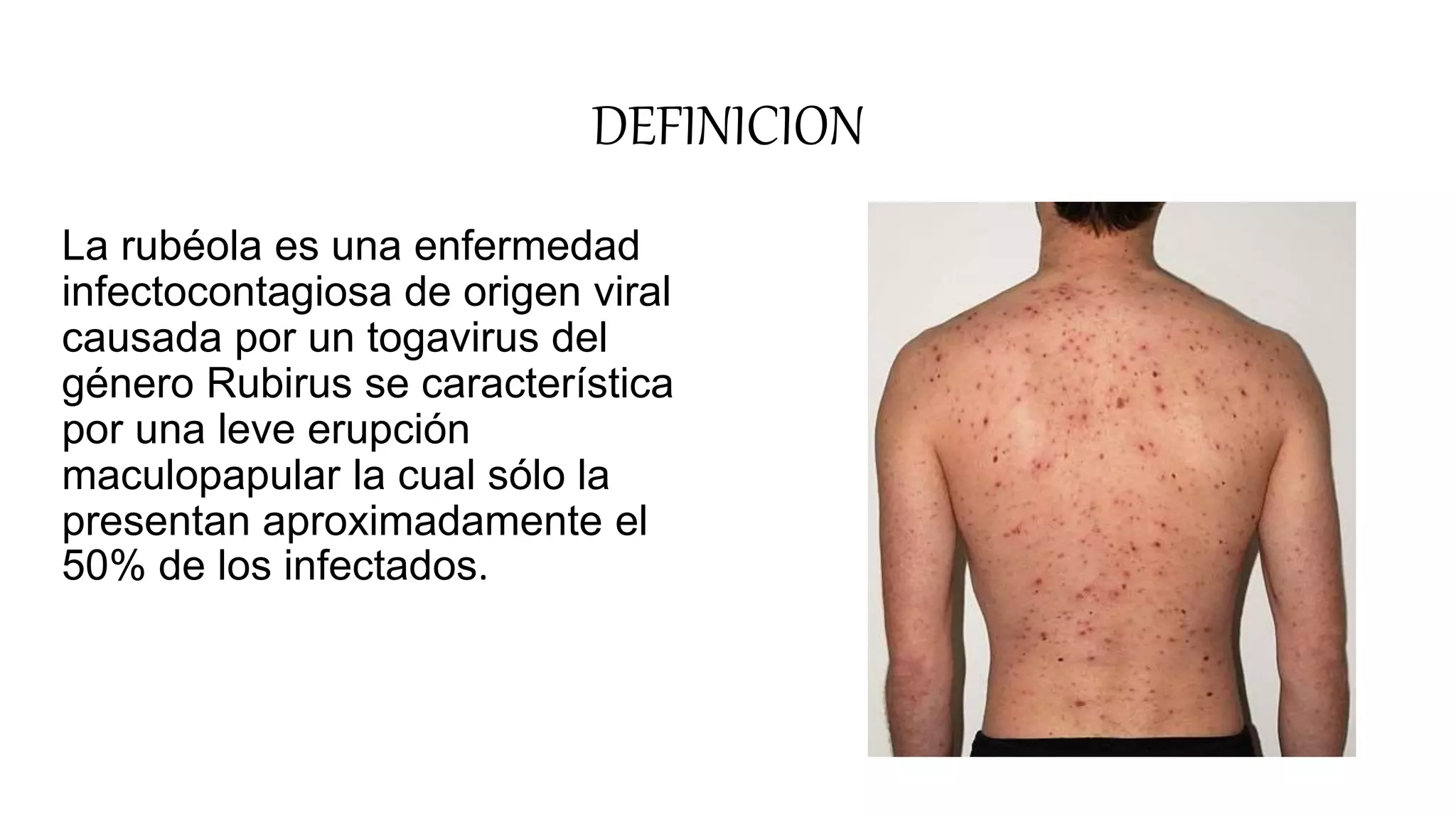 Fruth Rubeola Rubeola | PPT
